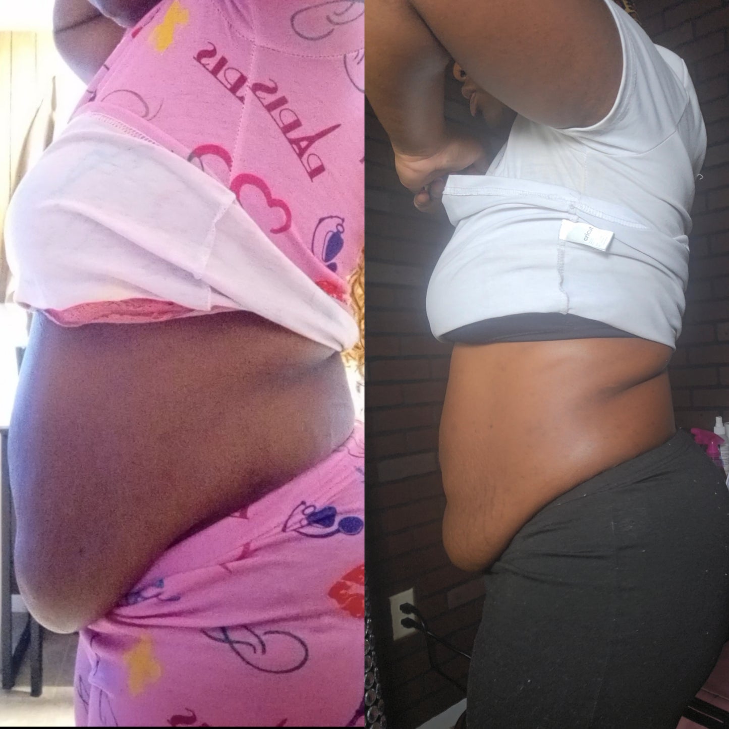 Mommy Makeover Treatment (Stomach & Sides)