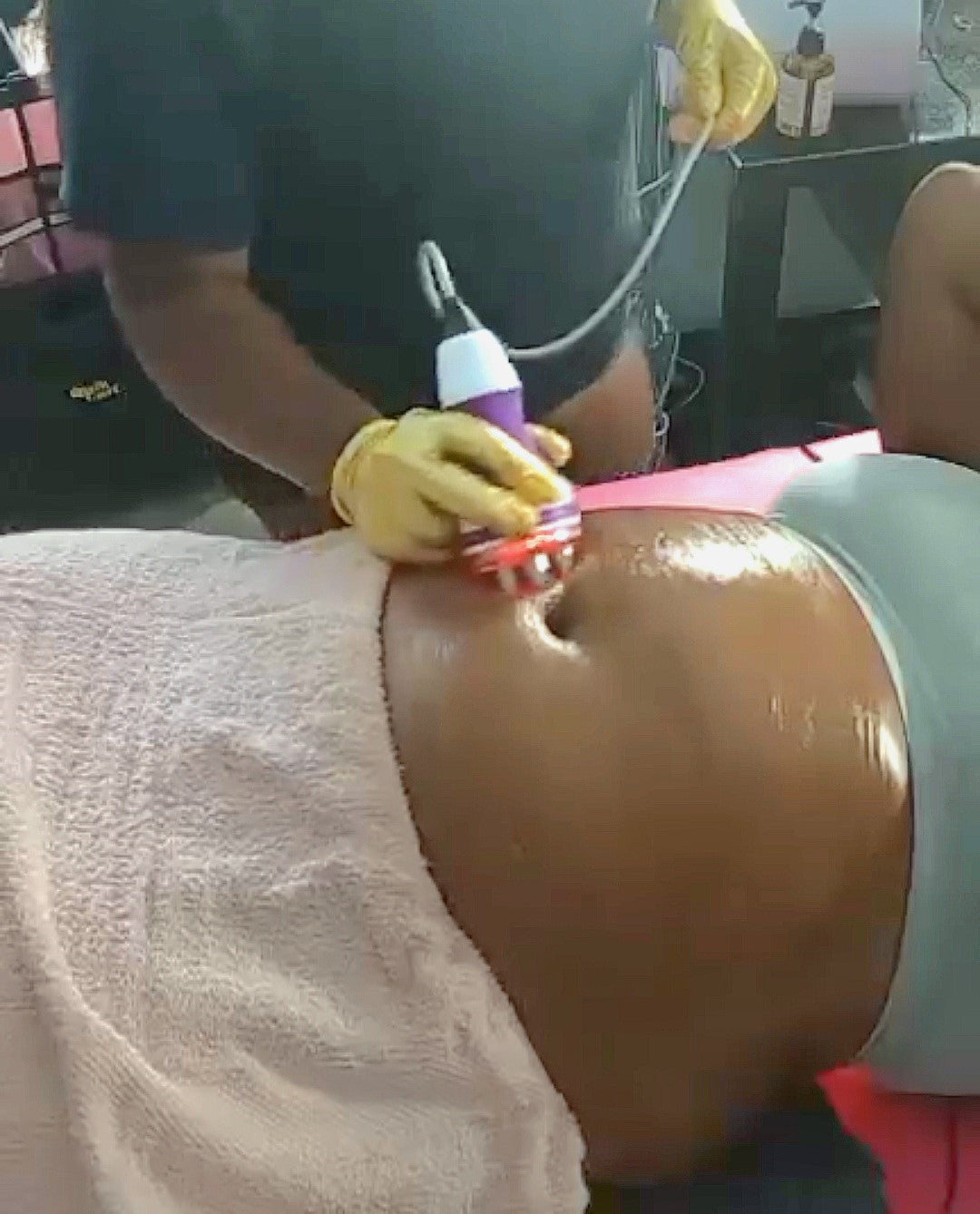 Radio Frequency Skin Tightening